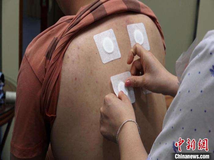 圖為醫(yī)生正在為民眾貼“三伏貼”。 唐蔚晴 攝